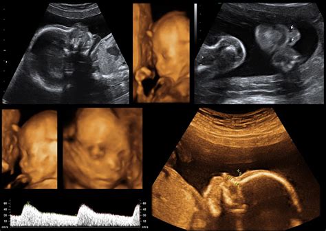 Understanding 2d 3d And 4d Pregnancy Ultrasounds International