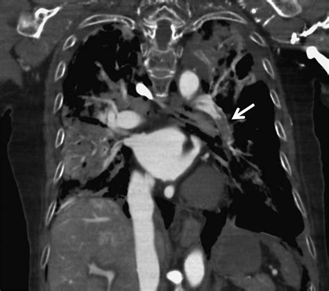 Post Mortem Contrast Enhanced Computed Tomography In A Case Of Sudden