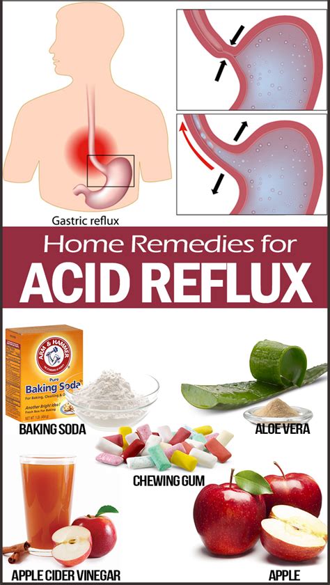 Home Remedies For Heartburn Causes Precautions And More Webshealth
