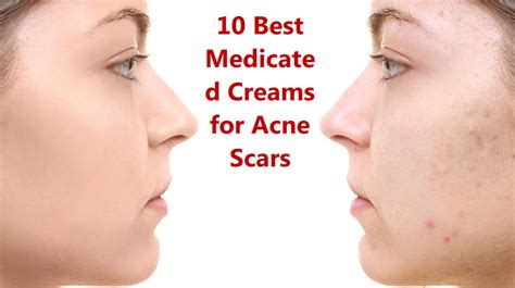 10 Best Medicated Creams For Acne Scars