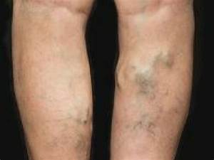 Varicose Veins Are A Real Risk To Your Health  Heart and Circulation Varicose Veins