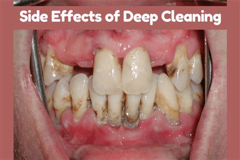 Scaling and root planing procedure: Deep Cleaning of Teeth Side Effects - How to Overcome it?