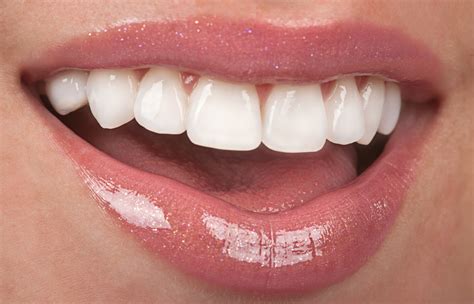 Dental Veneers Smile Essentials