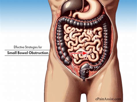 Effective Strategies For Small Bowel Obstruction A Team Based Treatment Plan