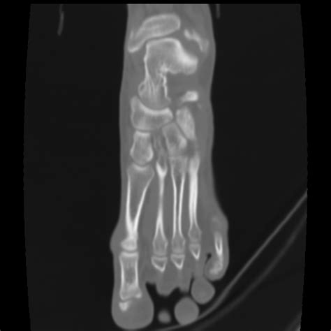 Avulsion Fracture Of The Dorsal Cuboid Bone Image