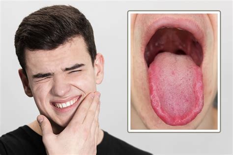 Burning Mouth Syndrome The Dental Hygienists Role In Assessment And