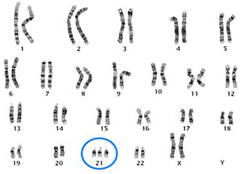 Karyotype Down Syndrome