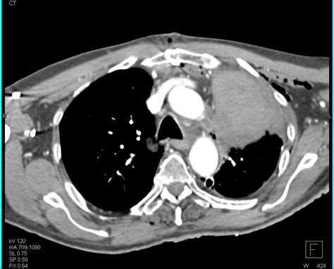 Left Upper Lobe Collapse Chest Case Studies Ctisus Ct Scanning