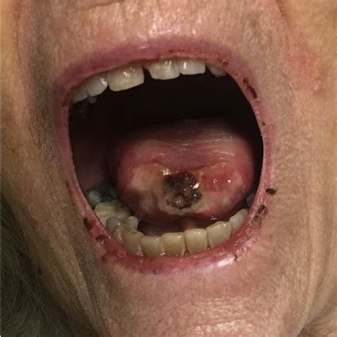 Giant Cell Arteritis Presenting With A Tongue Lesion The American