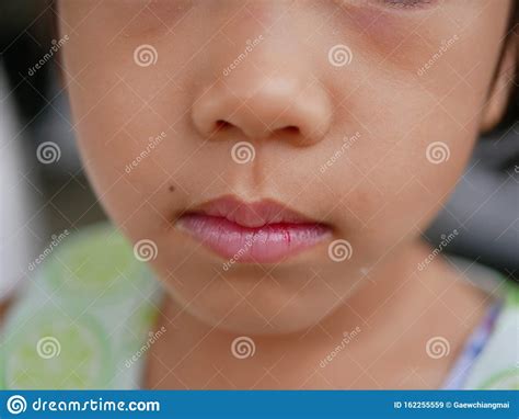 Closeup Of A Little Baby Girl`s Lips Got A Bit Of Bleeding On Her Lower