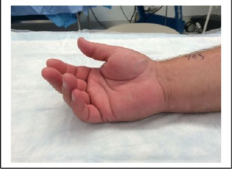 Figure From Chronic Exertional Compartment Syndrome Of The Hand Case