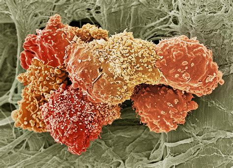Teratoma Cancer Cells Sem Photograph By Steve Gschmeissner