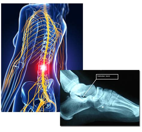 Back Pain