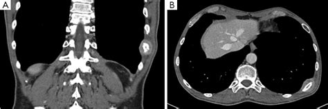 Solitary Rib Metastasis Of Nasopharyngeal Carcinoma Chinese Journal