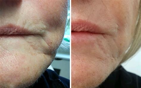 Dermal Fillers Renew Medical Aesthetics Cheshire Clinic