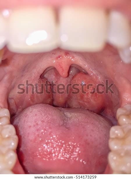 Tonsils Swollen Due To Inflammation In Patient