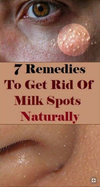 7 Remedies To Get Rid Of Milk Spots Naturally Skin Care Treatments
