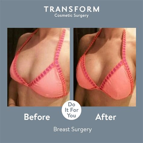 Transform On Twitter A Fantastic Before And After From One Of Our Patients Who Had A Breast