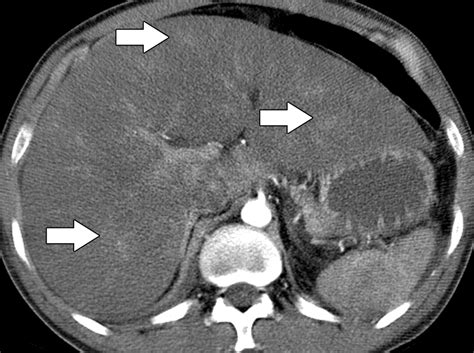 Diffuse Liver Disease Strategies For Hepatic Ct And Mr Imaging