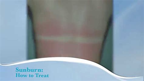 Shaking and shivering may accompany chills. How to treat sunburn - YouTube