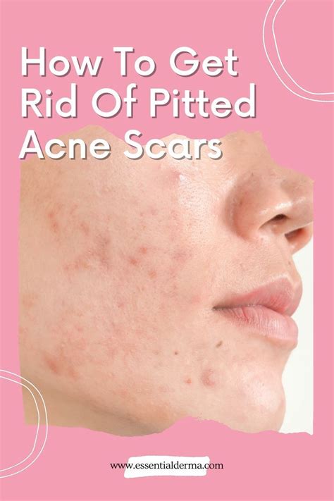 How To Get Rid Of Pitted Acne Scars Artofit