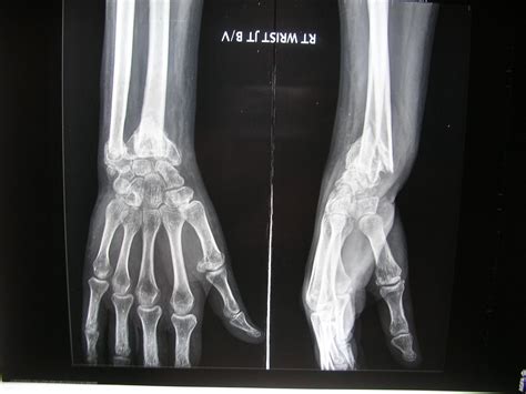 X Rays And Slides Malunion Of Distal Radius Ulna Fracture With