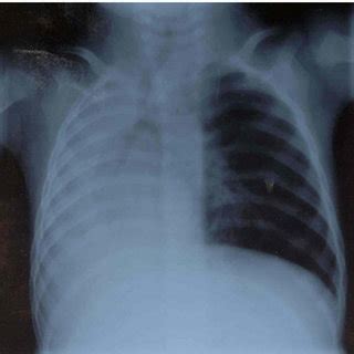 Chest X Ray Shows Persisting Total Atelectasis Of The Right Lung Note My Xxx Hot Girl