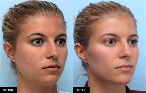 Jawline Filler For Definition And Contour Updated 2023 Mabrie Facial