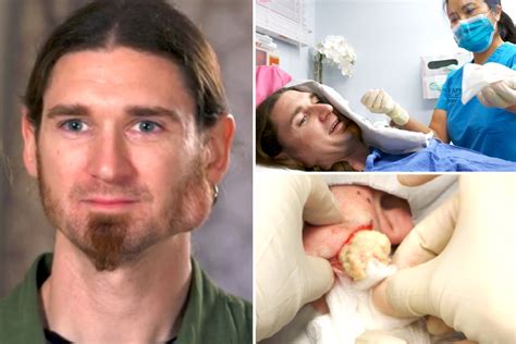Dr Pimple Popper Squeezes ‘jaw Breaking’ Cyst That Leaves Oatmeal Like Pus Oozing From His