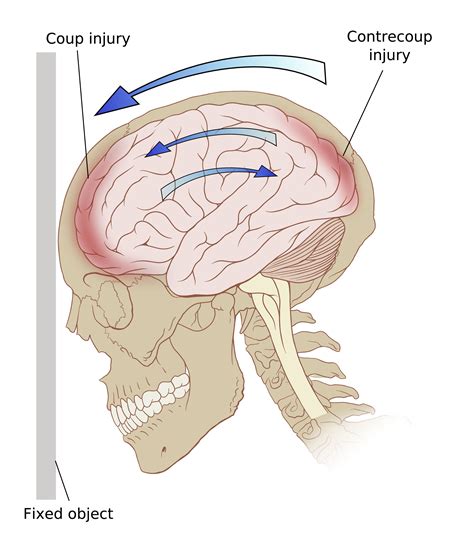 Neuropsychological Evaluation Of Traumatic Brain Injury The Definitive