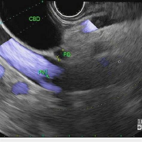 Endoscopic Ultrasound Showing Dilated Common Bile Duct In The Head Of