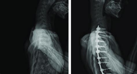 A Lateral X Ray Taken Preoperatively Demonstrating Thoracic Lordosis