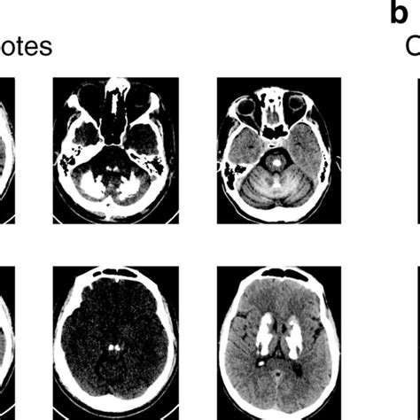 Findings In Computerized Tomography Ct Scans Associated With