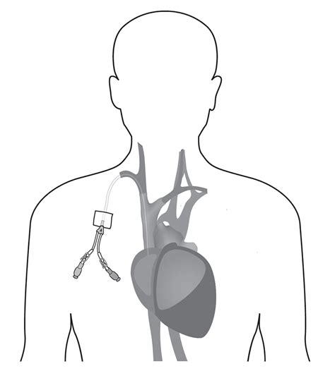 How To Manage Your Central Venous Access Device Cvad Leukemia