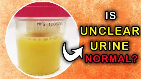 Cloudy Urine What Causes Unclear Or Milky Urine Youtube