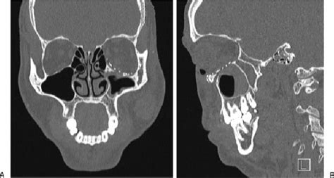 (A, B) Surgical management of the orbital floor fracture ...