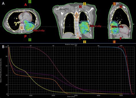 Radiotherapy Is Effective For A Primary Lung Cancer Invading The Left