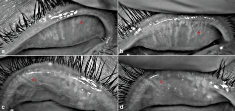 The Meibomian Gland Morphology Of A Patient With Chronic Download