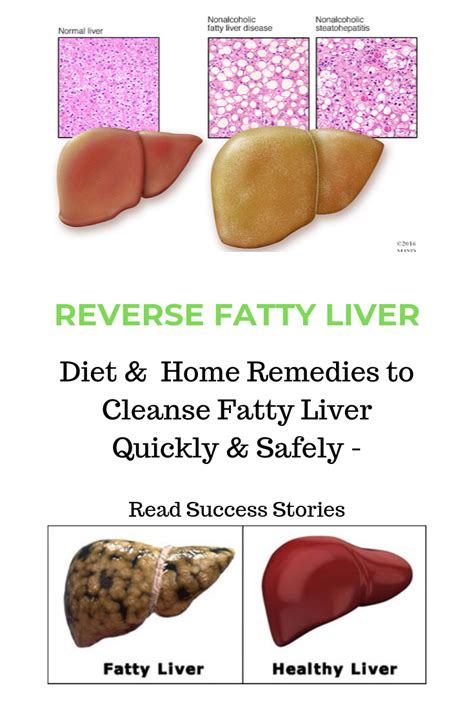 How To Reverse Fatty Liver Naturally With Home Remedies And Diet Fatty