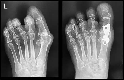 1st Mtpj Fusion Big Toe Arthrodesis David Redfern