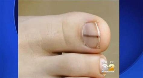 Black Spot Under Nail Unique Heres Why You Should See A Doctor If You