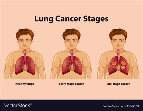 Informative Lung Cancer Stages Royalty Free Vector Image