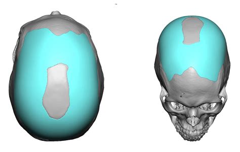 Plastic Surgery Case Study Sagittal Crest Skull Reduction With Custom