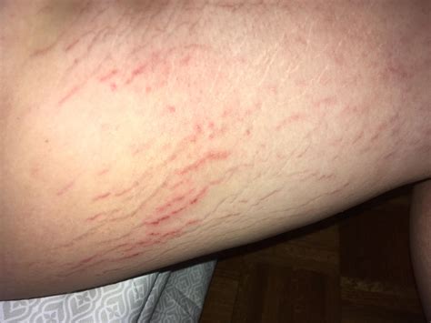 Stretch Marks On Inner Thighs