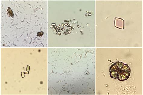 Identifying Crystals In The Urinary Sediment — Swissnephro