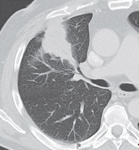 Pneumonia Radiology Key