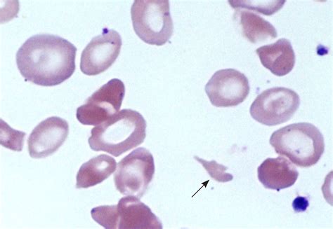 Hemolytic Disease Of The Newborn Blood Smear