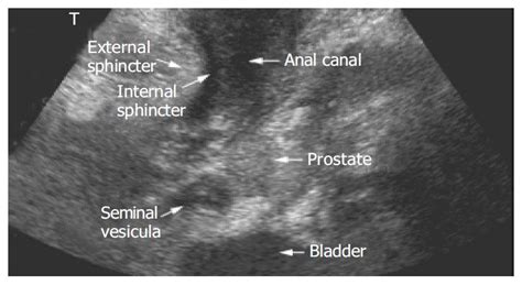 Transcutaneous Perianal Sonography A Sensitive Method For My Xxx Hot Girl