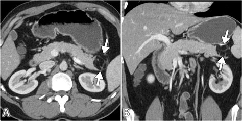 Cureus Lipoma Of The Pancreas A Rare Incidental Tumor