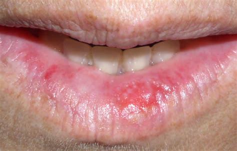 Skin Lesions On Lips